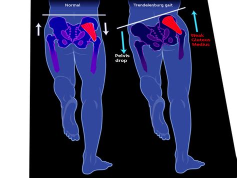 trendelenburg gait nerve damage